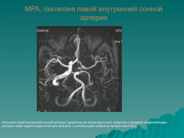 МРА, окклюзия левой внутренней сонной артерии Окклюзия левой внутренней сонной