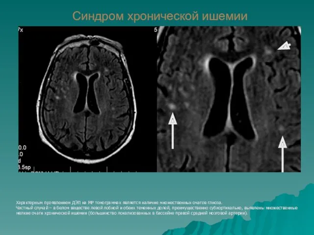 Синдром хронической ишемии Характерным проявлением ДЭП на МР томограммах является
