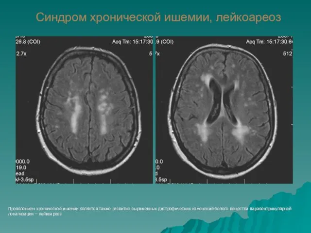 Синдром хронической ишемии, лейкоареоз Проявлением хронической ишемии является также развитие