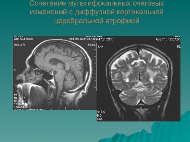 Сочетание мультифокальных очаговых изменений с диффузной кортикальной церебральной атрофией