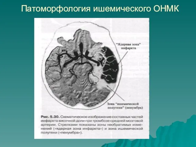 Патоморфология ишемического ОНМК