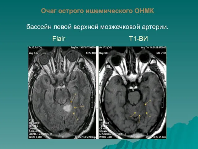 Очаг острого ишемического ОНМК бассейн левой верхней мозжечковой артерии. Flair Т1-ВИ