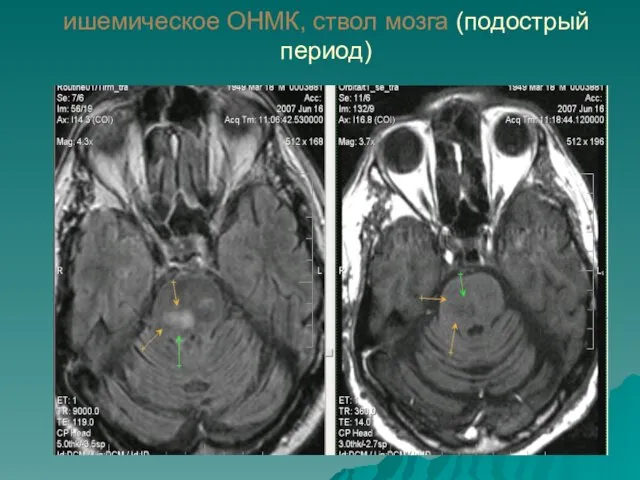 ишемическое ОНМК, ствол мозга (подострый период)