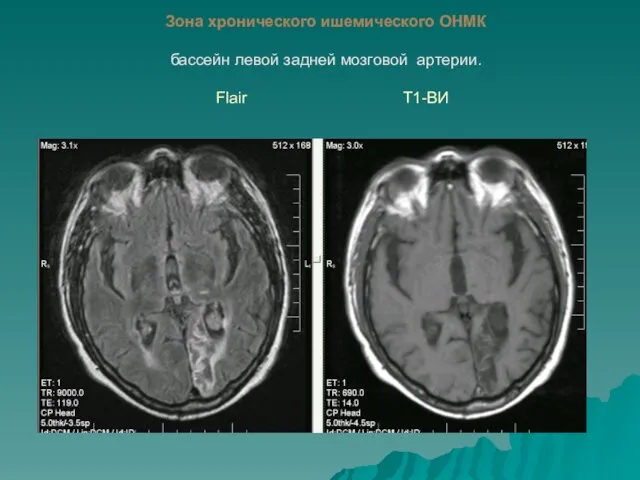 Зона хронического ишемического ОНМК бассейн левой задней мозговой артерии. Flair Т1-ВИ