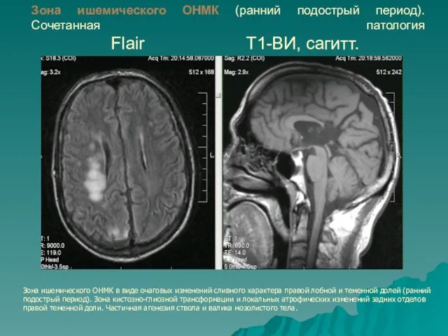 Зона ишемического ОНМК (ранний подострый период). Сочетанная патология Flair Т1-ВИ,