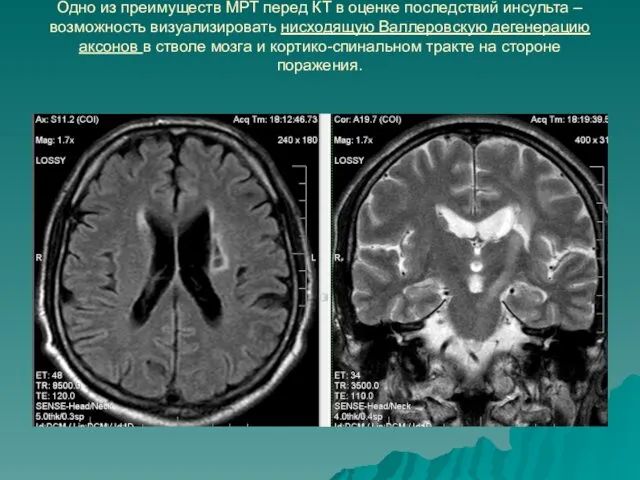 Одно из преимуществ МРТ перед КТ в оценке последствий инсульта