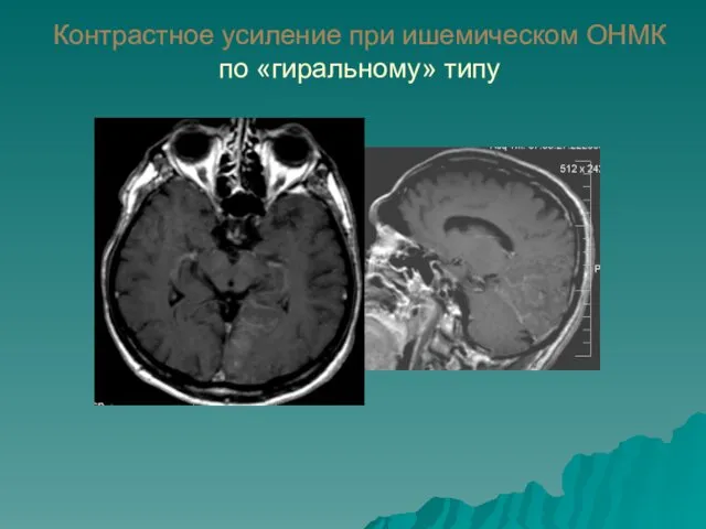 Контрастное усиление при ишемическом ОНМК по «гиральному» типу