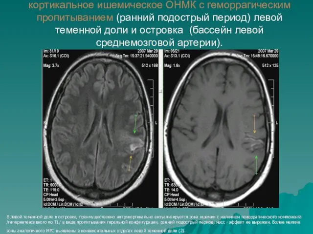 кортикальное ишемическое ОНМК с геморрагическим пропитыванием (ранний подострый период) левой