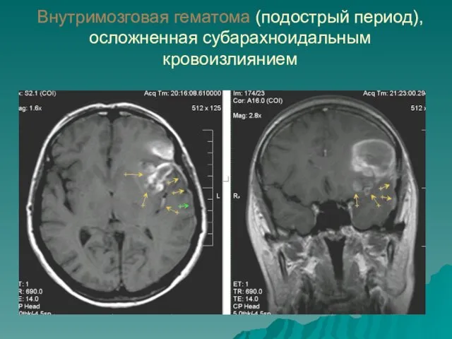 Внутримозговая гематома (подострый период), осложненная субарахноидальным кровоизлиянием