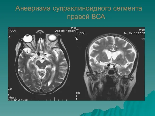 Аневризма супраклиноидного сегмента правой ВСА