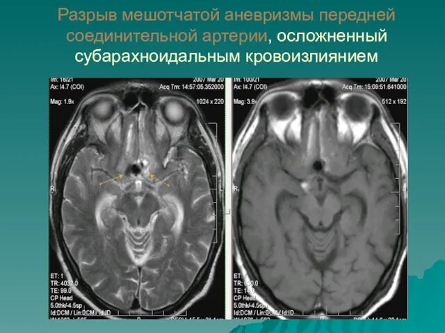 Разрыв мешотчатой аневризмы передней соединительной артерии, осложненный субарахноидальным кровоизлиянием