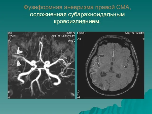 Фузиформная аневризма правой СМА, осложненная субарахноидальным кровоизлиянием.