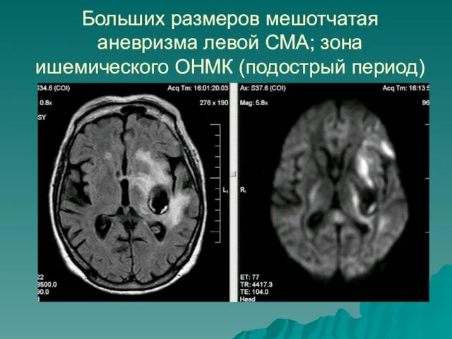 Больших размеров мешотчатая аневризма левой СМА; зона ишемического ОНМК (подострый период)