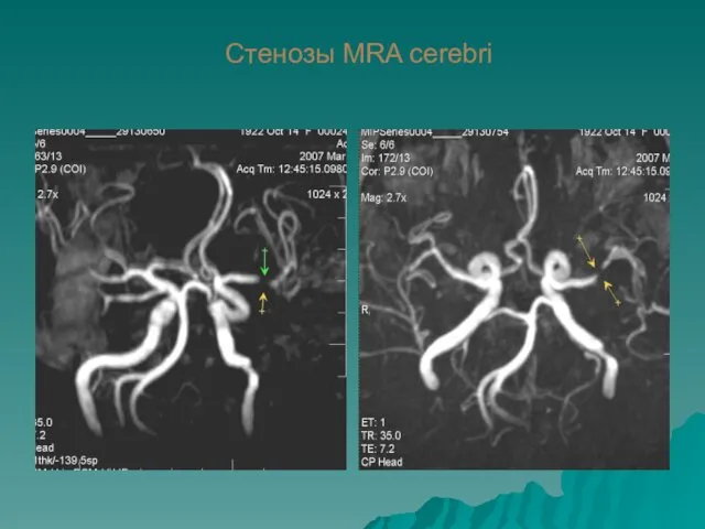 Стенозы MRA cerebri
