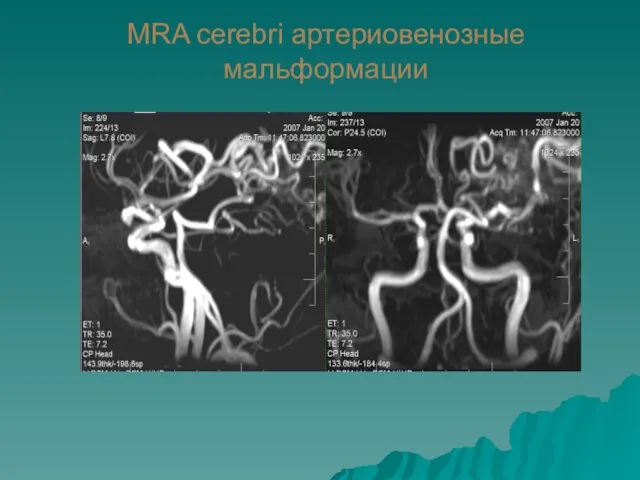 MRA cerebri артериовенозные мальформации