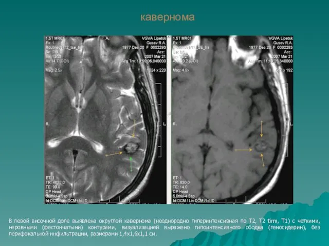 кавернома В левой височной доле выявлена округлой кавернома (неоднородно гиперинтенсивная