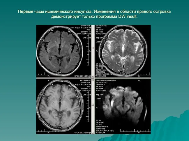 Первые часы ишемического инсульта. Изменения в области правого островка демонстрирует только программа DW insult.