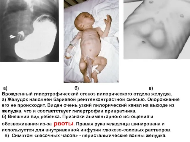 а) б) в) Врожденный гипертрофический стеноз пилорического отдела желудка. а) Желудок наполнен бариевой