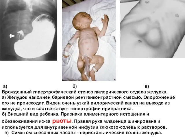 а) б) в) Врожденный гипертрофический стеноз пилорического отдела желудка. а)