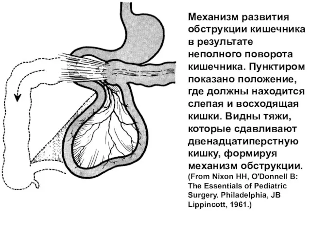 Механизм развития обструкции кишечника в результате неполного поворота кишечника. Пунктиром показано положение, где