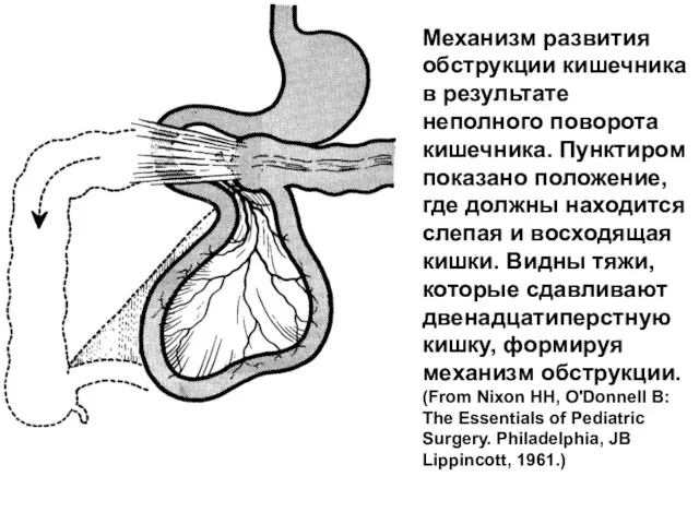 Механизм развития обструкции кишечника в результате неполного поворота кишечника. Пунктиром