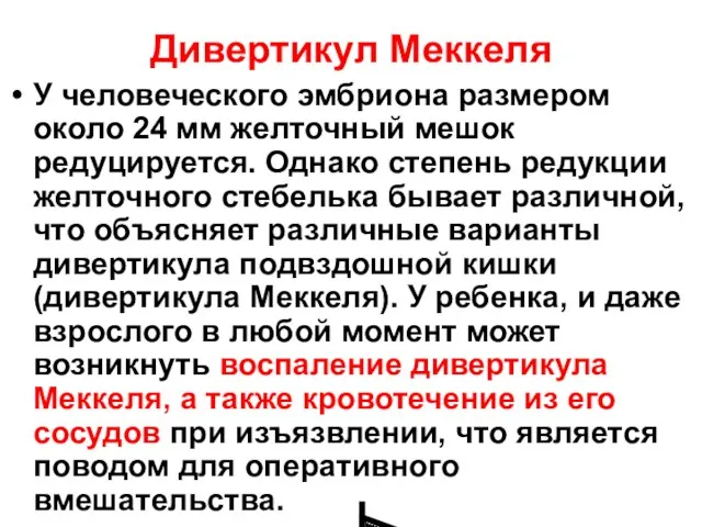 Дивертикул Меккеля У человеческого эмбриона размером около 24 мм желточный