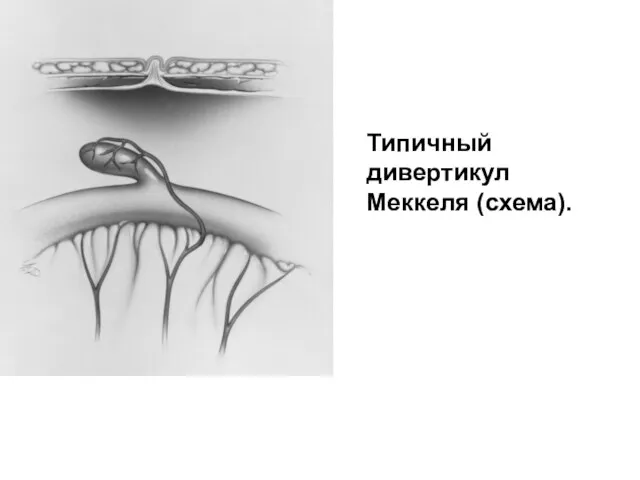 Типичный дивертикул Меккеля (схема).