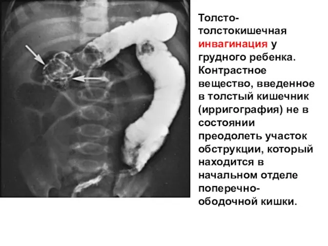 Толсто-толстокишечная инвагинация у грудного ребенка. Контрастное вещество, введенное в толстый кишечник (ирригография) не