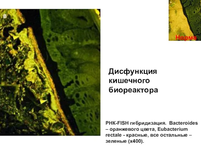 Норма Дисфункция кишечного биореактора РНК-FISH гибридизация. Bacteroides – оранжевого цвета, Eubacterium rectale -