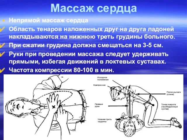 Массаж сердца Непрямой массаж сердца Область тенаров наложенных друг на