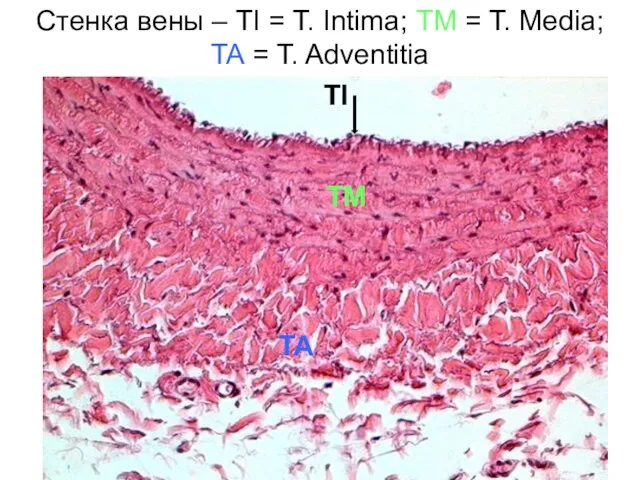 Стенка вены – TI = T. Intima; TM = T.