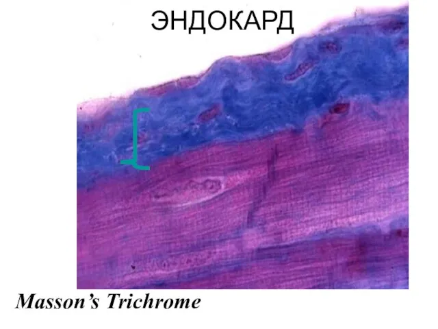 Masson’s Trichrome ЭНДОКАРД