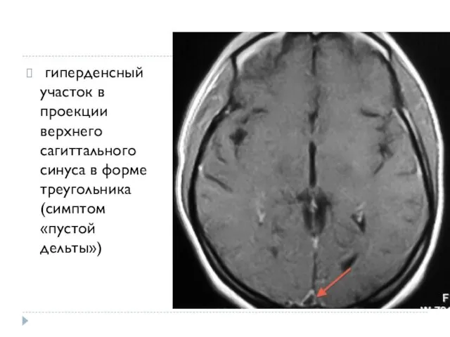 гиперденсный участок в проекции верхнего сагиттального синуса в форме треугольника (симптом «пустой дельты»)