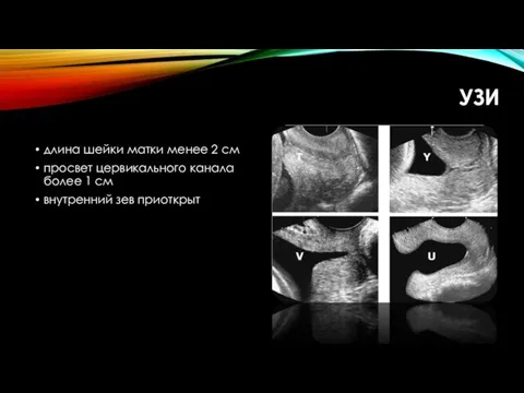 УЗИ длина шейки матки менее 2 см просвет цервикального канала более 1 см внутренний зев приоткрыт