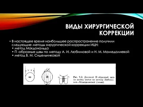 ВИДЫ ХИРУРГИЧЕСКОЙ КОРРЕКЦИИ В настоящее время наибольшее распространение получили следующие