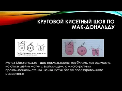 КРУГОВОЙ КИСЕТНЫЙ ШОВ ПО МАК-ДОНАЛЬДУ Метод Макдональда - шов накладывается