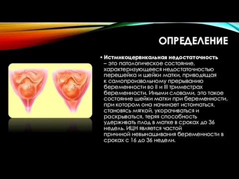 ОПРЕДЕЛЕНИЕ Истмикоцервикальная недостаточность – это патологическое состояние, характеризующееся недостаточностью перешейка