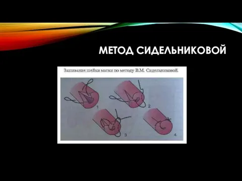 МЕТОД СИДЕЛЬНИКОВОЙ