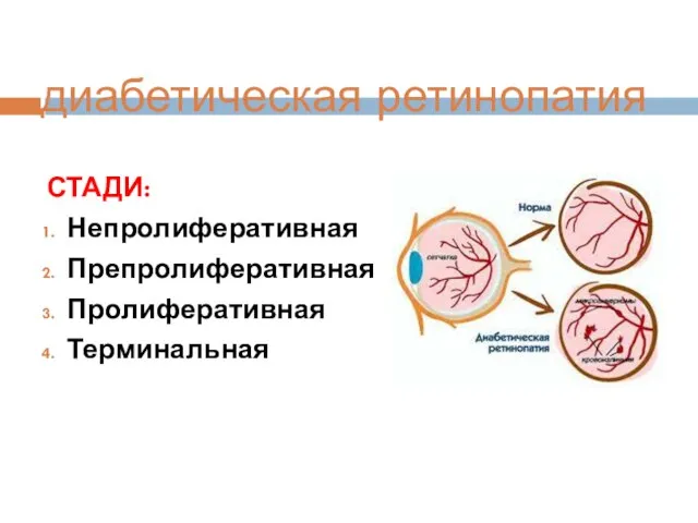 диабетическая ретинопатия СТАДИ: Непролиферативная Препролиферативная Пролиферативная Терминальная