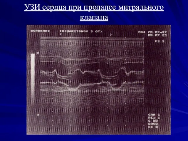 УЗИ сердца при пролапсе митрального клапана