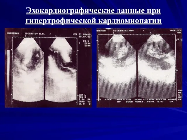 Эхокардиографические данные при гипертрофической кардиомиопатии