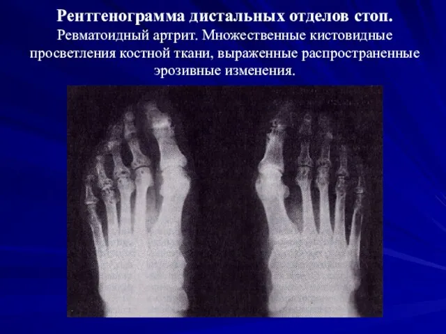 Рентгенограмма дистальных отделов стоп. Ревматоидный артрит. Множественные кистовидные просветления костной ткани, выраженные распространенные эрозивные изменения.