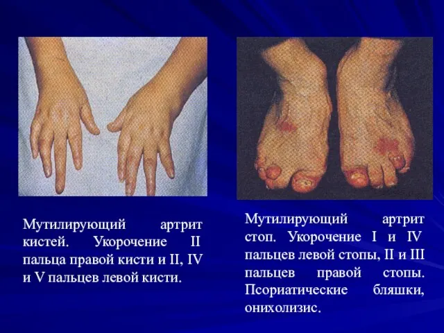 Мутилирующий артрит кистей. Укорочение II пальца правой кисти и II,