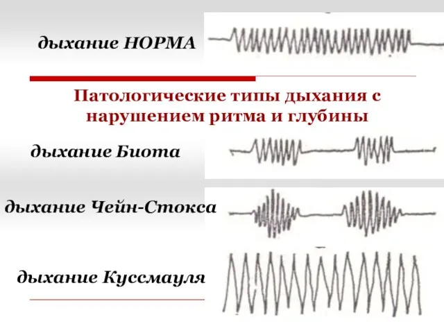 Патологические типы дыхания с нарушением ритма и глубины дыхание Биота дыхание Чейн-Стокса дыхание Куссмауля дыхание НОРМА