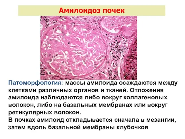 Амилоидоз почек Патоморфология: массы амилоида осаждаются между клетками различных органов и тканей. Отложения