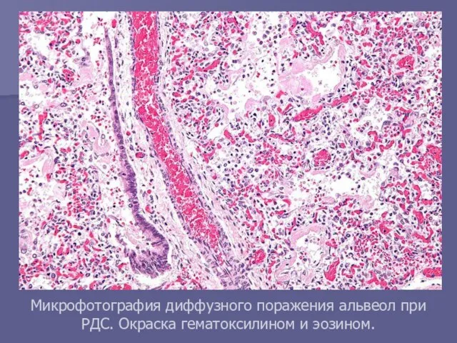 Микрофотография диффузного поражения альвеол при РДС. Окраска гематоксилином и эозином.