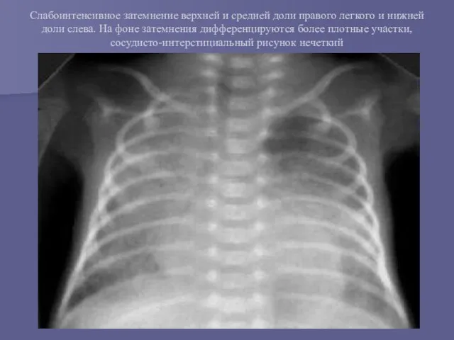 Слабоинтенсивное затемнение верхней и средней доли правого легкого и нижней