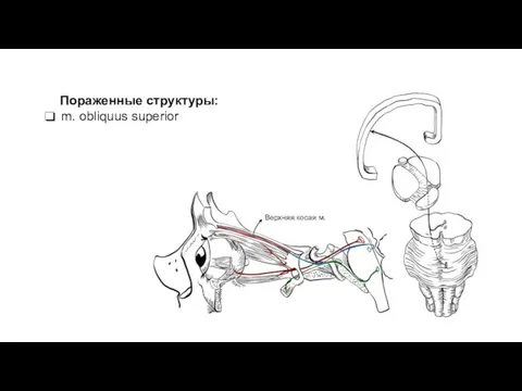 Пораженные структуры: m. obliquus superior Верхняя косая м.