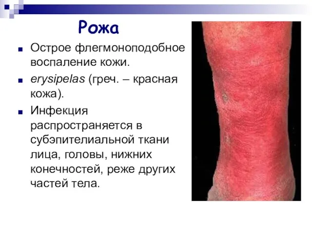 Рожа Острое флегмоноподобное воспаление кожи. erysipelas (греч. – красная кожа). Инфекция распространяется в