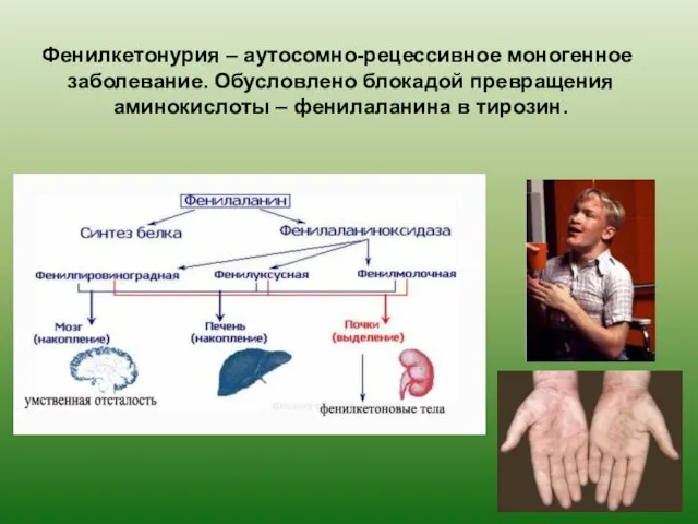 Фенилкетонурия – аутосомно-рецессивное моногенное заболевание. Обусловлено блокадой превращения аминокислоты – фенилаланина в тирозин.